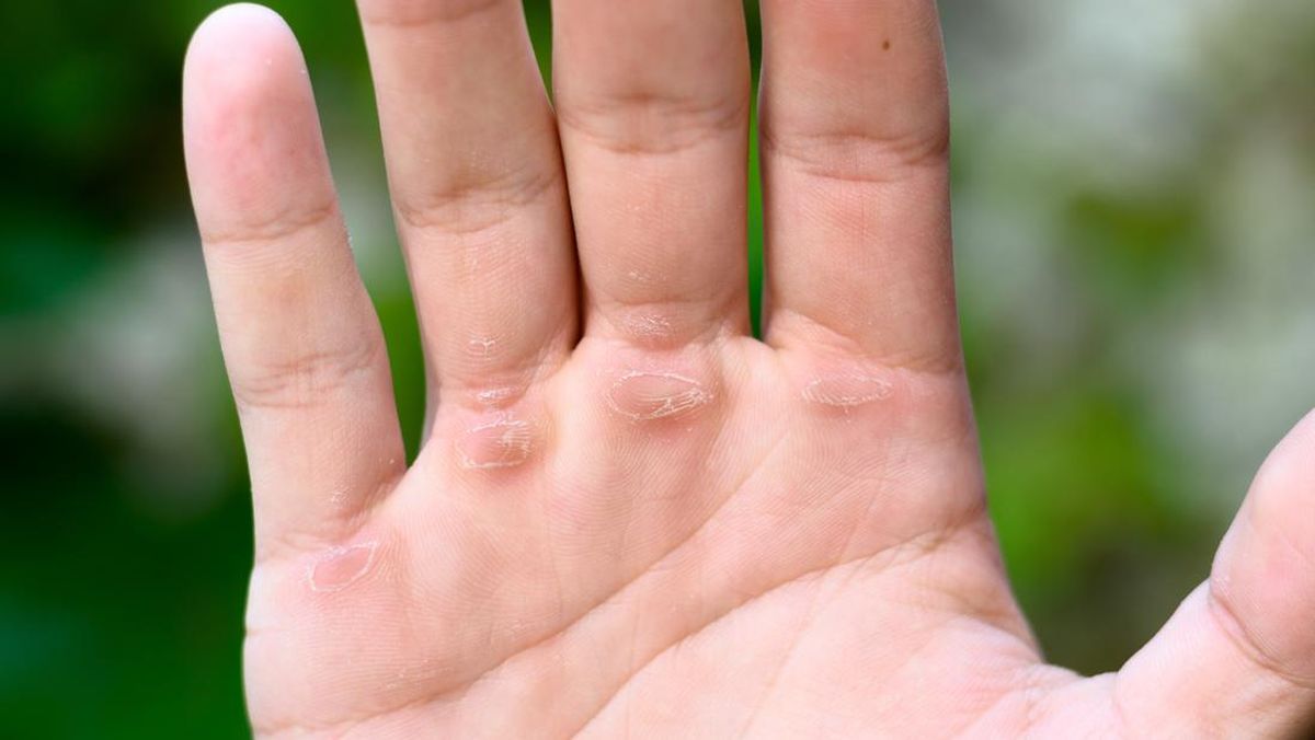 Cara Menghilangkan Kapalan di Tangan Secara Alami dan Cepat